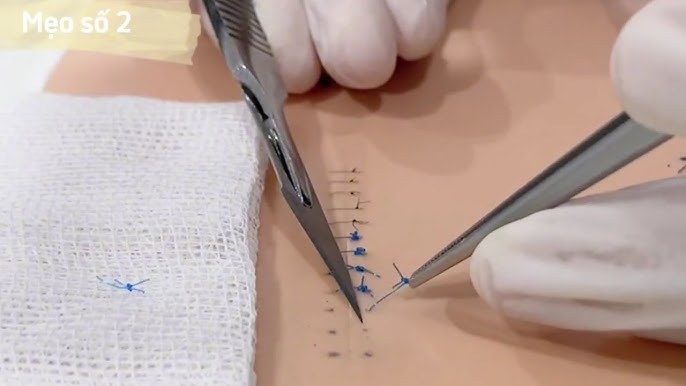 Quy trình cắt chỉ vết thương và vết mổ như thế nào ? - Cắt chỉ tại nhà với y tế  Đức Hạnh